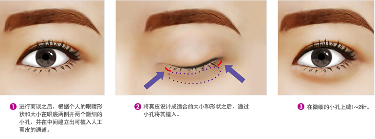 人工真皮丰卧蚕