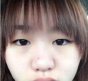 埋线双眼皮手术恢复