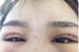 埋线双眼皮手术恢复