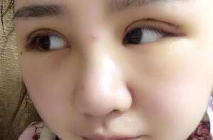 埋线双眼皮手术恢复