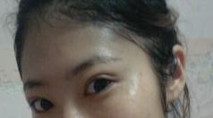 单眼皮女生不愿再贴双眼皮贴