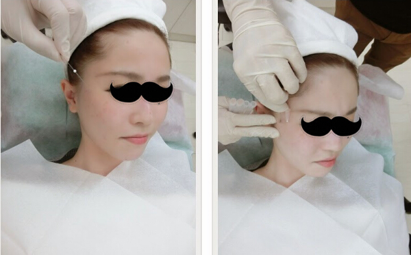 案例：埋线提拉一做 大小脸不见了！