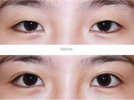 双眼皮手术前后对比