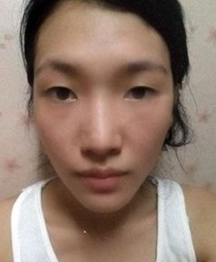 “涵山涵瑶凌瑶”进行双眼皮手术前样子