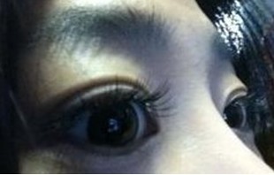 　做完双眼皮手术1个月后样子