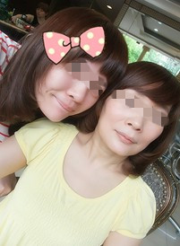 做电波拉皮后1个月