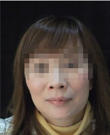 电波拉皮后1星期