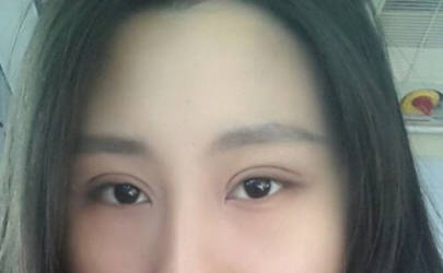 内双美女不愿再贴双眼皮贴 毅然做切开双眼皮术7