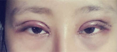 内双美女不愿再贴双眼皮贴 毅然做切开双眼皮术3