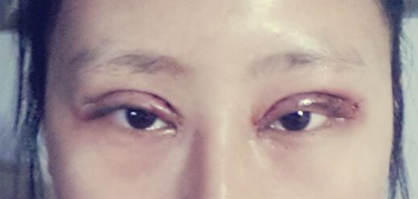 内双美女不愿再贴双眼皮贴 毅然做切开双眼皮术2