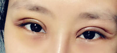 内双美女不愿再贴双眼皮贴 毅然做切开双眼皮术5