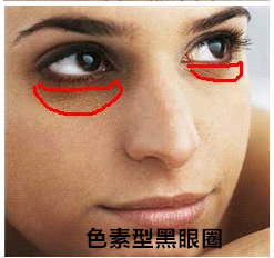 色素型黑眼圈