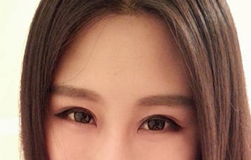 内双美女不愿再贴双眼皮贴 毅然做切开双眼皮术9