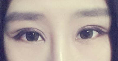 内双美女不愿再贴双眼皮贴 毅然做切开双眼皮术8