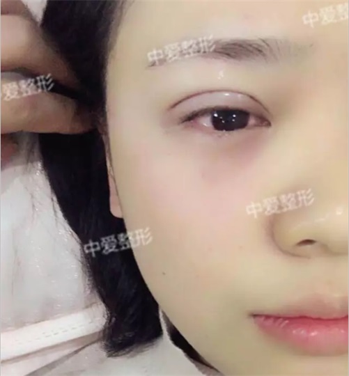 埋线双眼皮