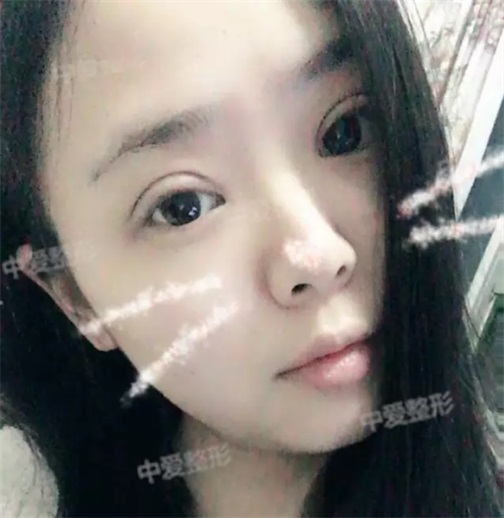 埋线双眼皮