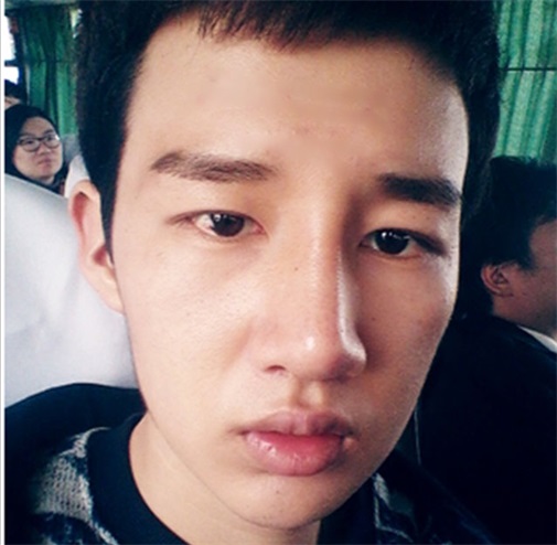 双眼皮 开眼角 定制隆鼻 隆下颏