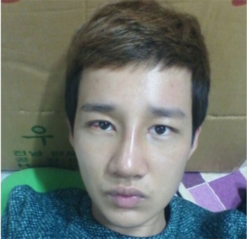 双眼皮 开眼角 定制隆鼻 隆下颏