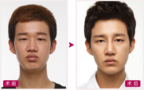 双眼皮 开眼角 定制隆鼻 隆下颏