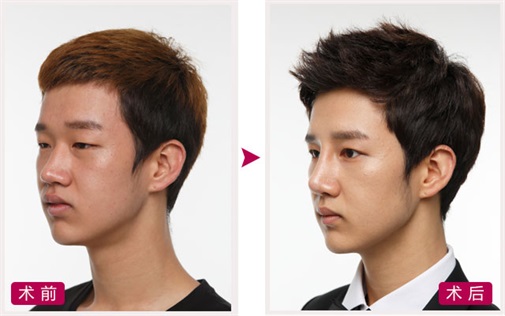 双眼皮 开眼角 定制隆鼻 隆下颏