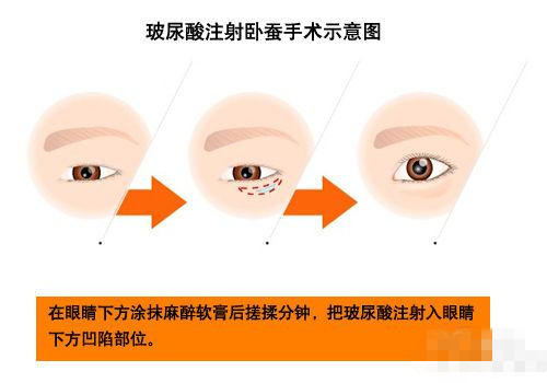 做卧蚕整形也可拥有桃花眼