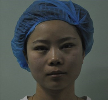 割双眼皮+开内眼角 “假小子”焱焱成功蜕变