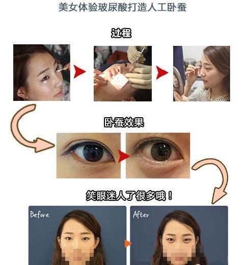 图解：玻尿酸填充卧蚕