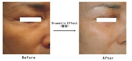 韩式射频点阵御肤术对比图