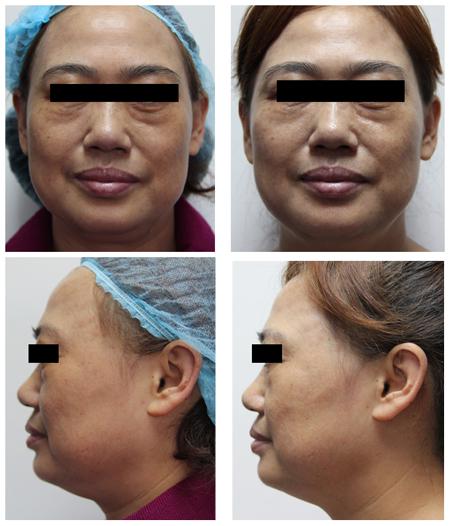 韩式射频点阵御肤术对比图