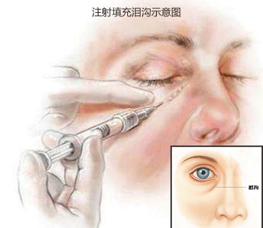 注射填充泪沟示意图