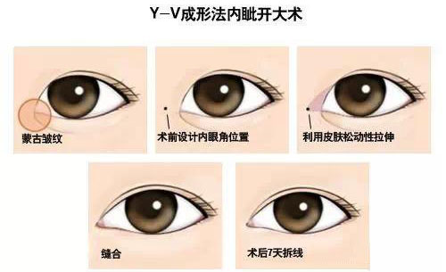 什么是开眼角？