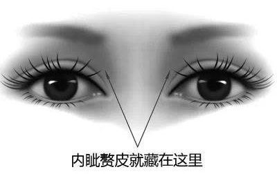 什么是内眦赘皮？