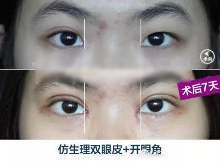 女大学生眼部整形告别大小眼