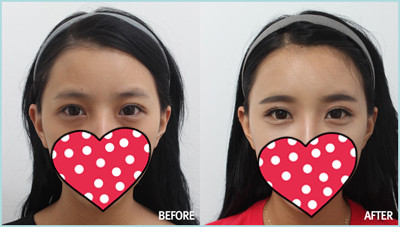 关于注射玻尿酸再造卧蚕的效果