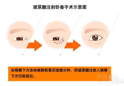 关于注射玻尿酸再造卧蚕的过程