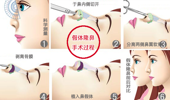 假体隆鼻要剥离骨膜