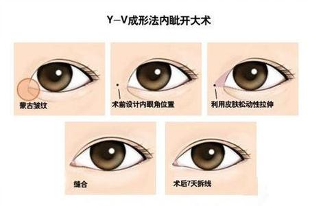 开内眼角担心留疤？深圳美度李晓平教你怎么办