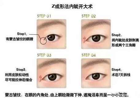 开内眼角担心留疤？深圳美度李晓平教你怎么办