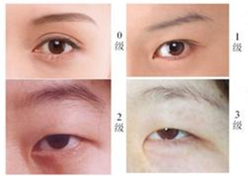 开内眼角担心留疤？深圳美度李晓平教你怎么办