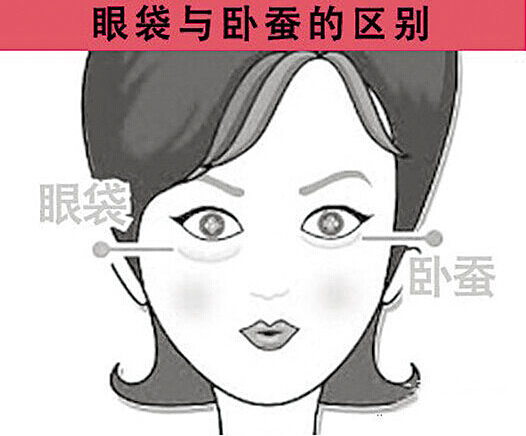 关于卧蚕和眼袋的区别