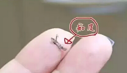 半永久纹眉后痂皮脱落