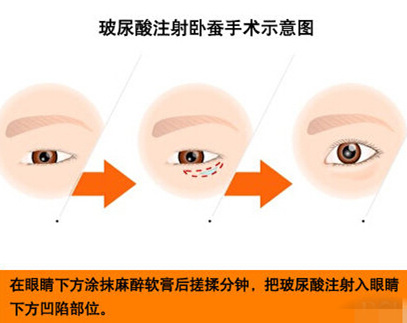 注射伊婉玻尿酸丰卧蚕 你真的了解它吗？