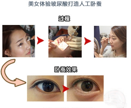 瑞蓝玻尿酸无痕丰卧蚕过程