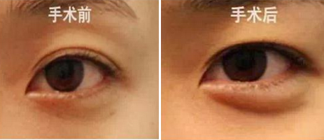 　瑞蓝玻尿酸无痕丰卧蚕对比照