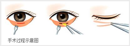 手术祛眼袋