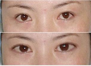 开眼角手术
