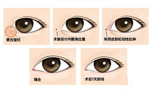 割双眼皮和开眼角哪个好？