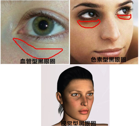 眼袋和黑眼圈的区别