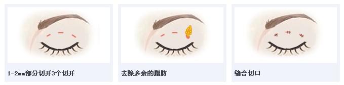 韩式三点双眼皮