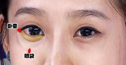 不知道卧蚕和眼袋的区别